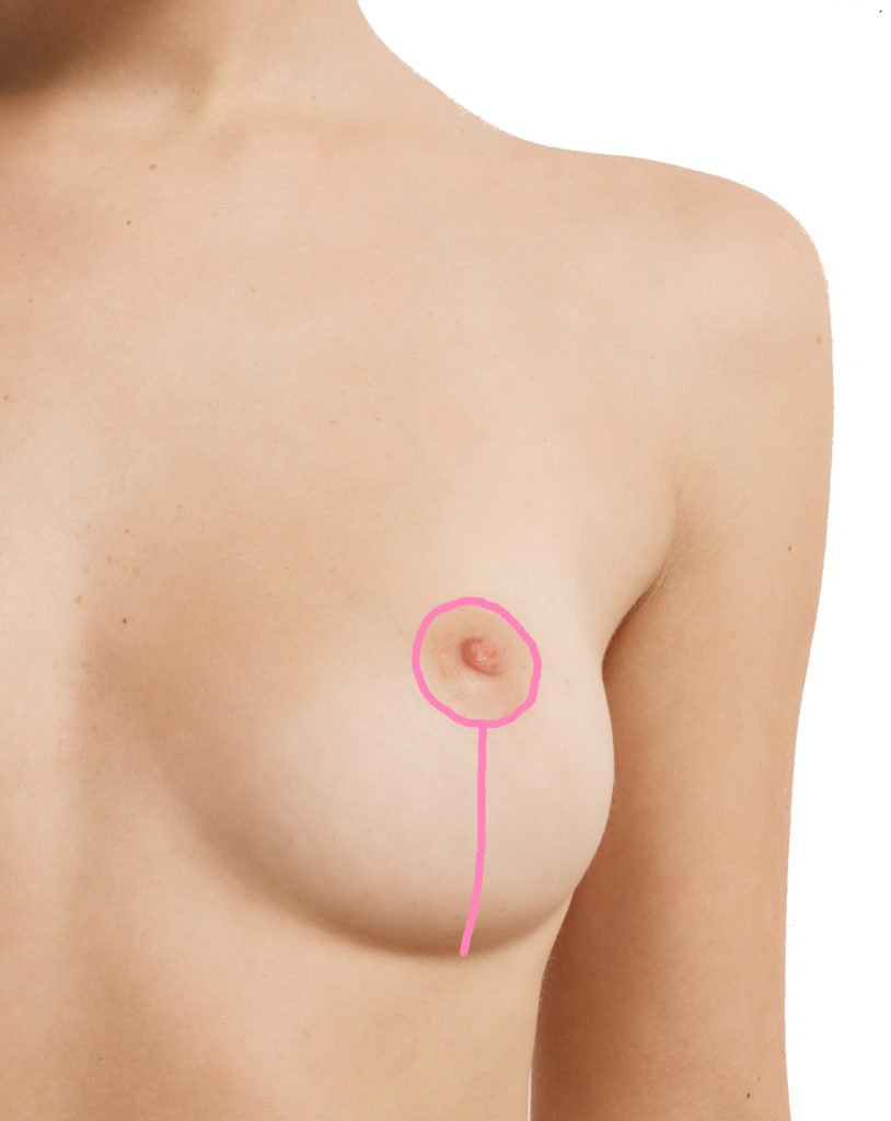 Typical Breast Lift Scar - Mastopexy Scar