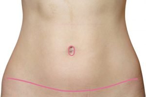 Typical Tummy Tuck Scar - Abdominoplasty Scar