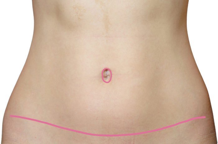 Warning Signs After Tummy Tuck?