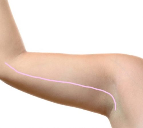 Arm Lift Scar - Brachioplasty Scar