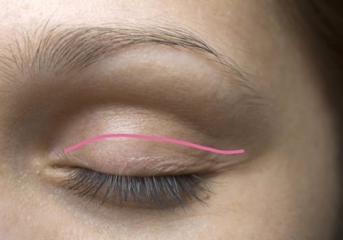 Typical Eyelid Lift Scar - Blepharoplasty