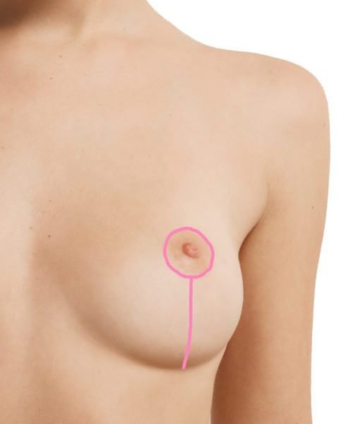 Typical Breast Lift Scar - Mastopexy Scar