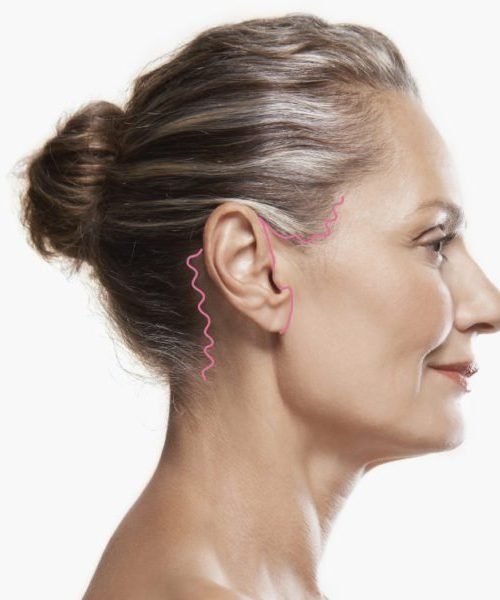 Typical Facelift Scar- Rhytidectomy